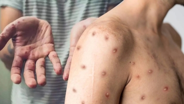 Dünya Sağlık Örgütü, M çiçeği virüsü sebebiyle 'küresel acil durum' ilan etti