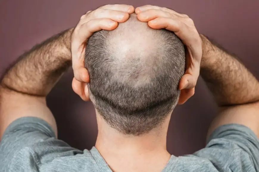 Tıp tarihinde dönüm noktası: Erkek tipi kellik için ilaç bulundu