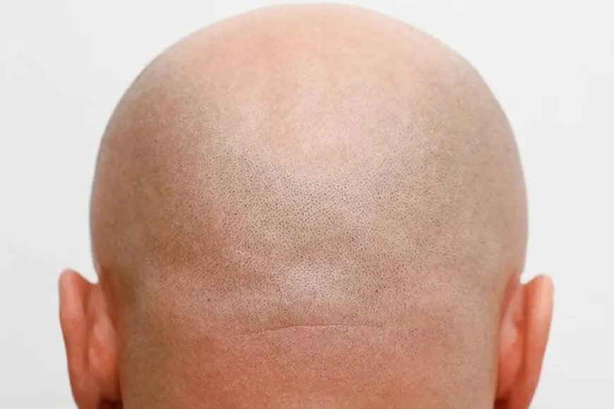 Saç dökülmesine karşı bin yıllık bitkiden yeni umut