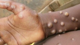 Şewba Monkeypoxê, li cîhanê belav dibe