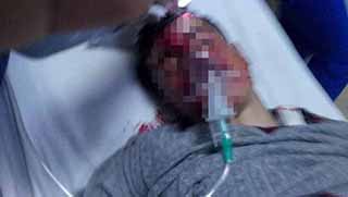 Şırnak'ta gaz bombası kapsülünün isabet ettiği çocuk ağır yaralandı 