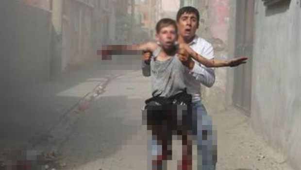 Cizre'de Özel Harekat Timlerinin bıraktığı bomba bir çocuğun elini parçaladı