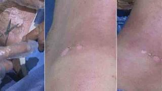 Peşmerge Güçlerine kimyasal saldırı