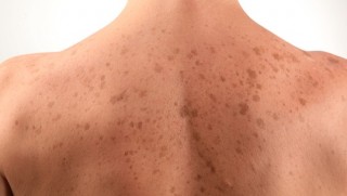 Avustralyalı araştırmacılar en ölümcül cilt kanseri tipini durduran bir yöntem buldular