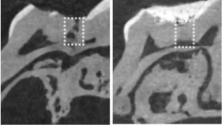 Çürük dişleri iyileştiren ilaç geliştirildi