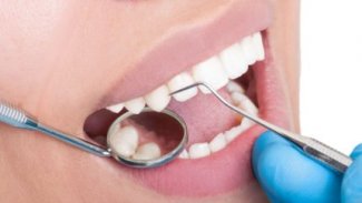 Diş minesini onaran jelle dolgular tarih oluyor