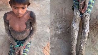 7 yaşındaki kız çocuğu taşlaşıyor