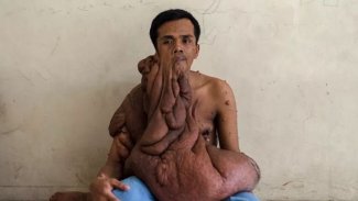 Yüzündeki leke 40 kilogramlık tümöre dönüştü