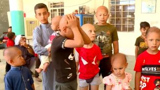 Kerkük'te tanımlanamayan bir hastalık nedeniyle 40 çocuğun saçları döküldü