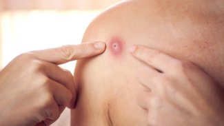 Dünyada yeni salgın...Beş Soruda Maymun Çiçeği