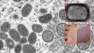 Maymun çiçeği virüsü bir ülkeye daha sıçradı