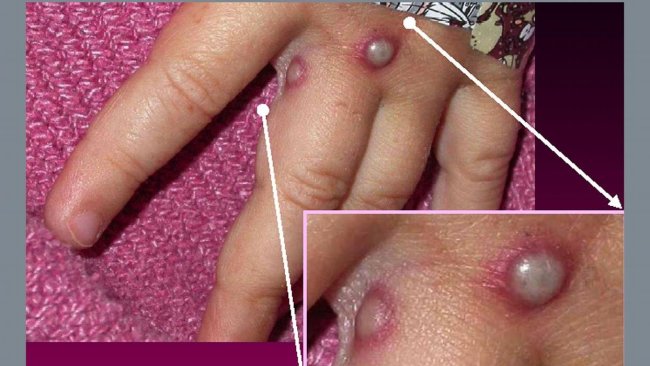 DSÖ'den Avrupa'ya maymun çiçeği uyarısı