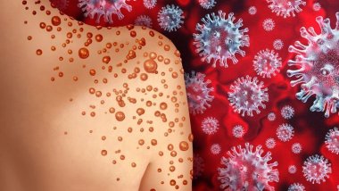 Nijerya'da maymun çiçeği virüsünden ilk ölüm 