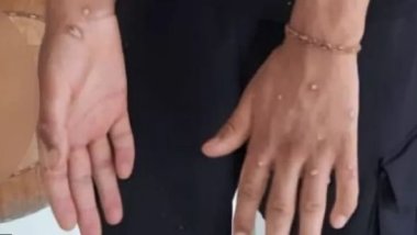 Maymunçiçeği virüsü: İstanbul'da üç kişi karantinaya alındı