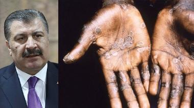 Türkiye'de ilk maymun çiçeği vakası