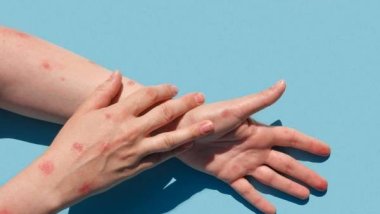 DSÖ: Avrupa, maymun çiçeği salgınının merkezi olmayı sürdürüyor