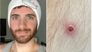 Maymun çiçeğine yakalanan kişi semptomları anlattı