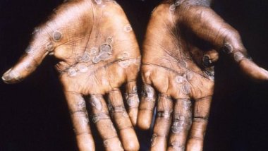 Maymun çiçeği virüsünün yeni belirtileri keşfedildi