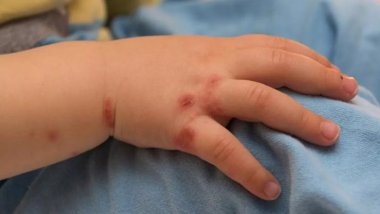 Yeni salgın patlak verdi: 5 yaş altı çocuklar tehlikede!