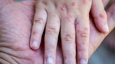 Türkiye'de Maymun çiçeği vaka sayısı yükseldi