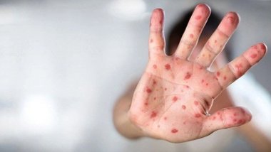 DSÖ maymun çiçeği raporunu yayımladı!