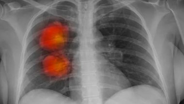 Araştırma: Kanseri erken teşhis edebilen yapay zeka modeli geliştirildi