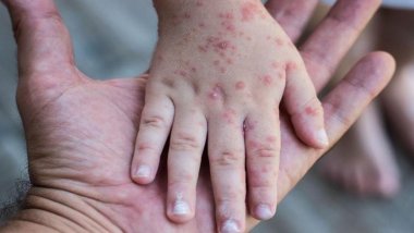 Türkiye'de Kızamık vakalarında korkutan artış: İstanbul'da 2 çocuk hayatını kaybetti